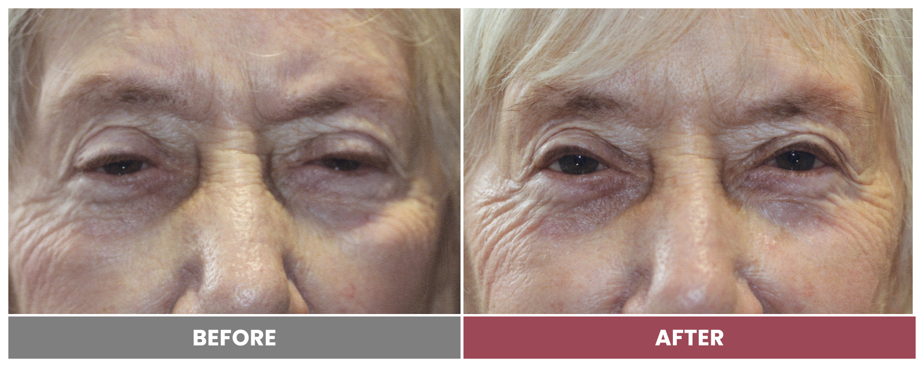 PTOSIS REPAIR - Case 36